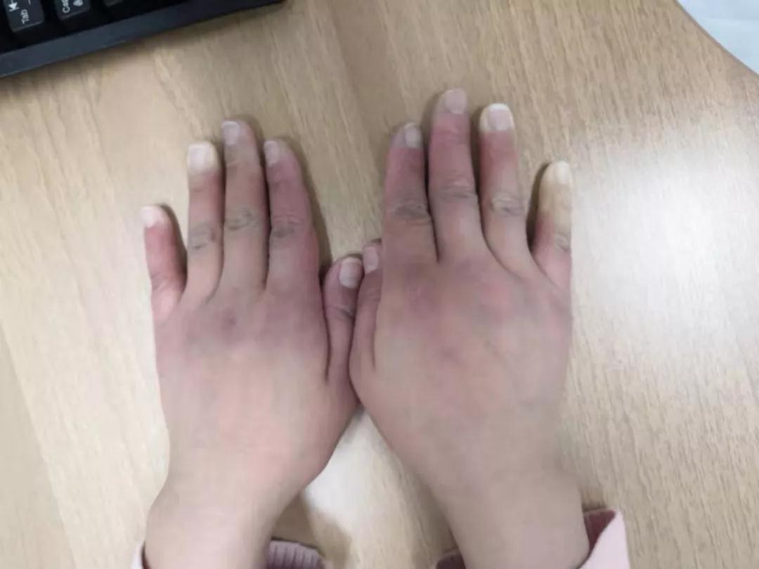 “手指、腳趾發(fā)白、發(fā)紫……”這些“小毛病”千萬(wàn)別大意