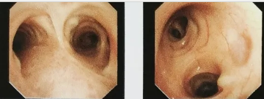 西安國際醫(yī)學中心醫(yī)院成功開展首例鞘管引導的經支氣管鏡冷凍肺活檢術GS-TBLC