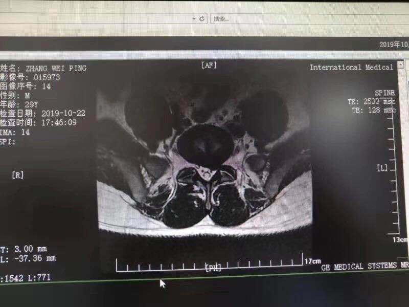 西安國際醫(yī)學中心骨科醫(yī)院成功完成首臺椎間孔鏡手術(shù)