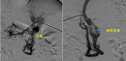 血栓攔路，如何破局——罕見(jiàn)巨大門靜脈血栓TIPS手術(shù)實(shí)錄