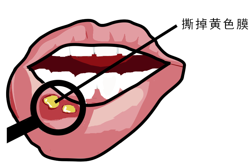 經(jīng)?？谇粷?，真的只是缺維生素嗎？