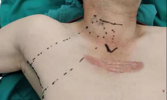 術(shù)后傷口可以“隱身”嗎？