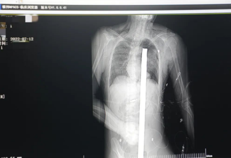 1.2米長(zhǎng)的鋼筋貫穿男子胸腹！情況極度危險(xiǎn)......