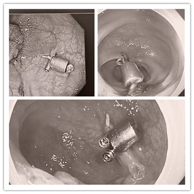 消化病醫(yī)院內(nèi)外科聯(lián)合開展3例“磁環(huán)預(yù)標(biāo)記輔助腹腔鏡結(jié)、直腸癌根治術(shù)”