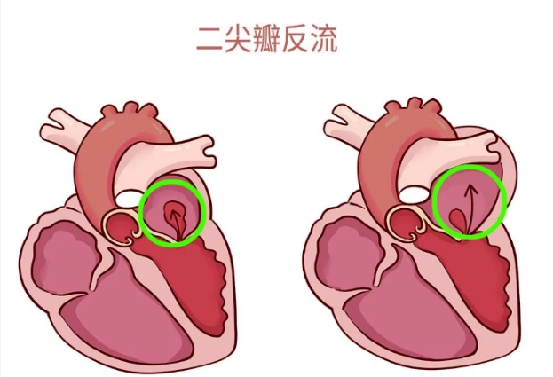 體檢報(bào)告里的心臟瓣膜反流，你讀懂了嗎？