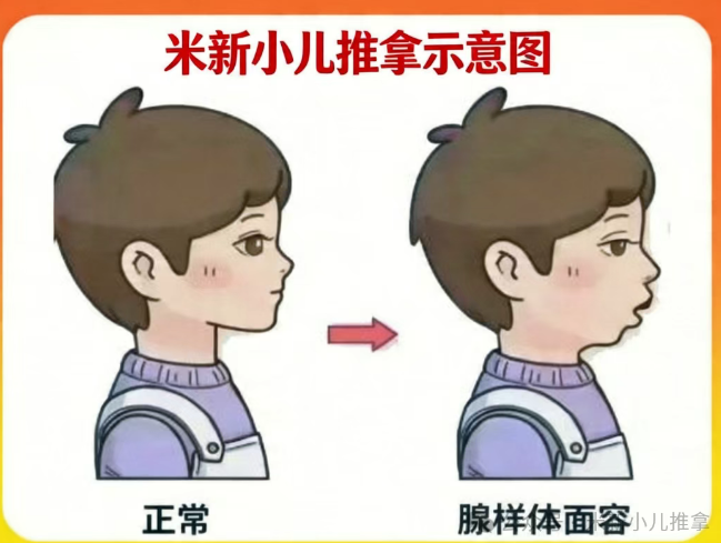 兒童腺樣體肥大只能手術(shù)？不，一位媽媽的親身經(jīng)歷給出另一種答案